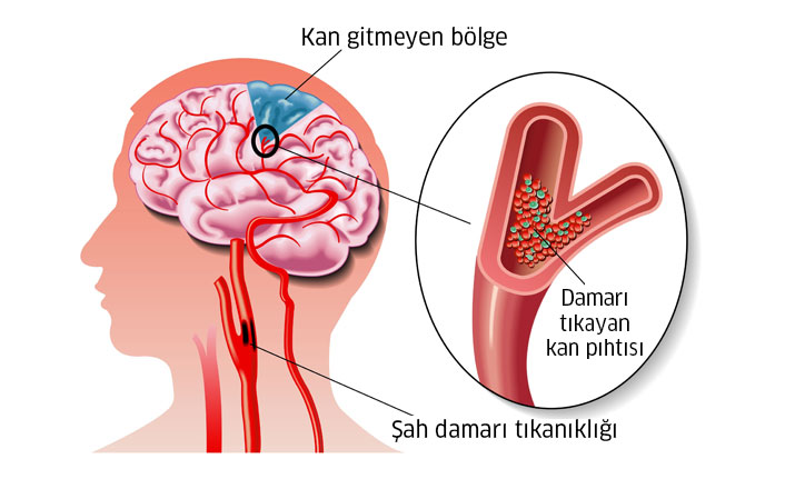 Beyin Damar Tikanikligi Belirtileri Ve Tedavisi