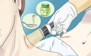 Yara İzlerini Geçirmek İçin Doğal ve Tıbbi Yöntemler